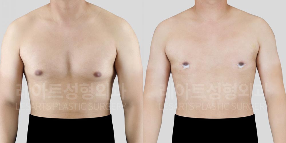 gynecomastia-02-03-260720