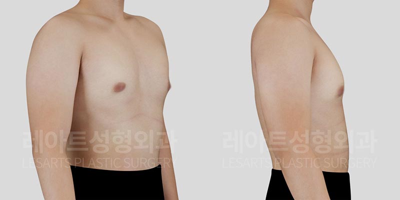 gynecomastia-02-03-260729