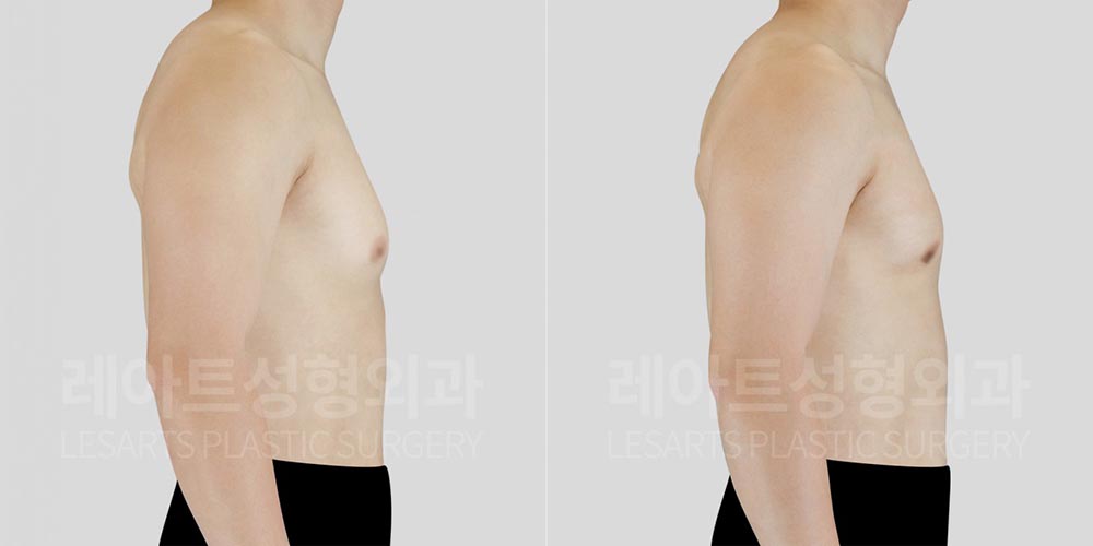 gynecomastia-02-03-260803