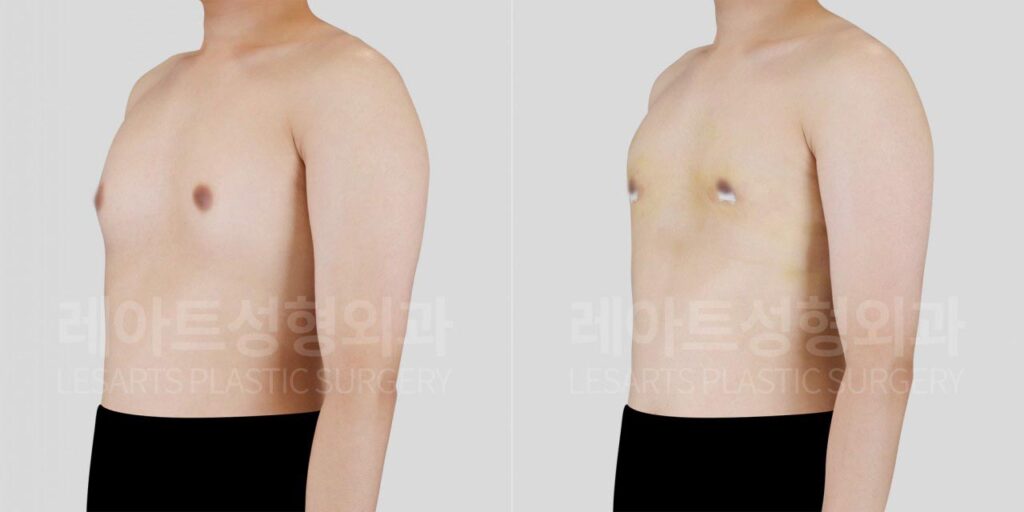 gynecomastia-02-03-260810