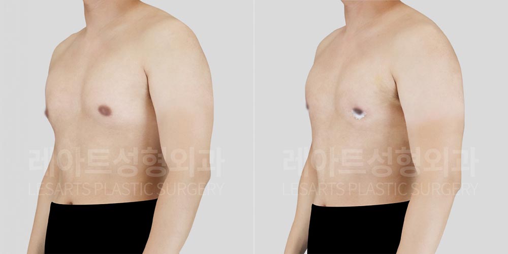 gynecomastia-02-04-260720