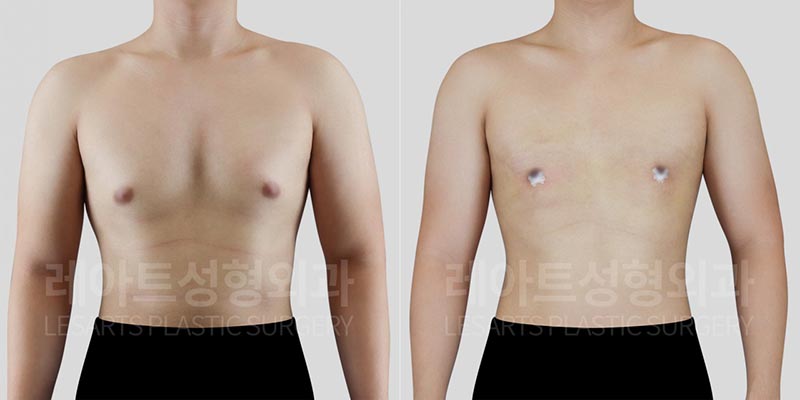 lesarts gynecomastia before and after