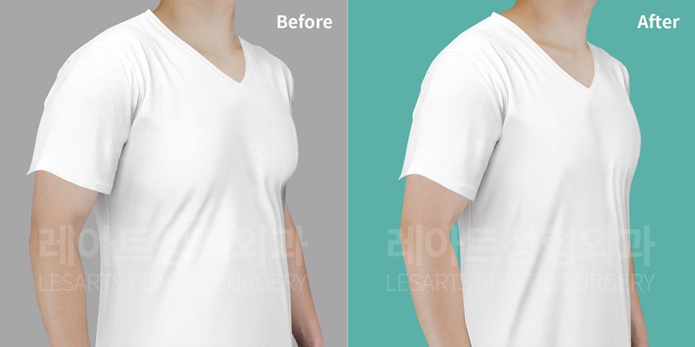 gynecomastia-02-04-260803