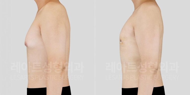 lesarts gynecomastia before and after