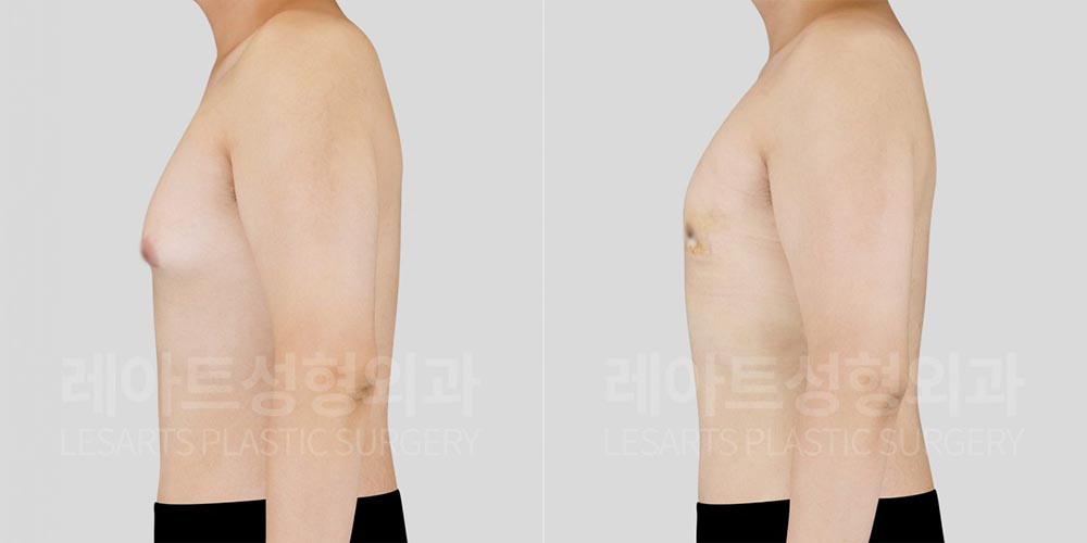 lesarts gynecomastia before and after