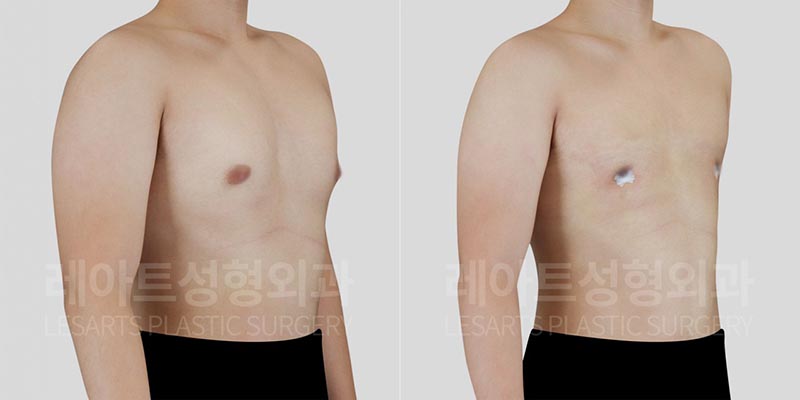 gynecomastia-02-05-260729