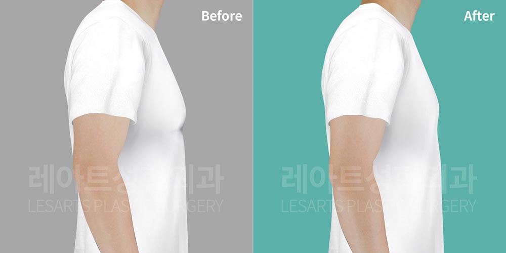 gynecomastia-02-05-260803