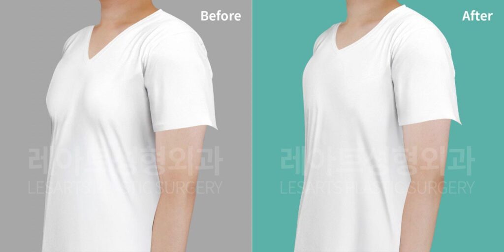 gynecomastia-02-05-260810