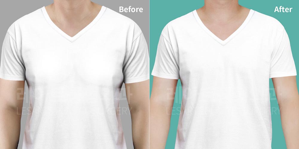 gynecomastia-02-06-260720