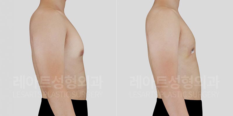 gynecomastia-02-06-260729