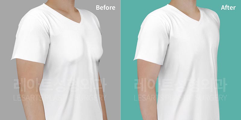 gynecomastia-02-07-260729