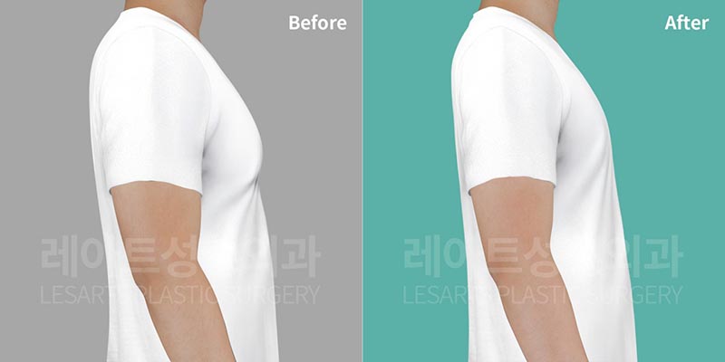 gynecomastia-02-08-260729