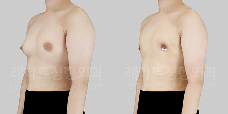 gynecomastia-33003-before-after-45deg