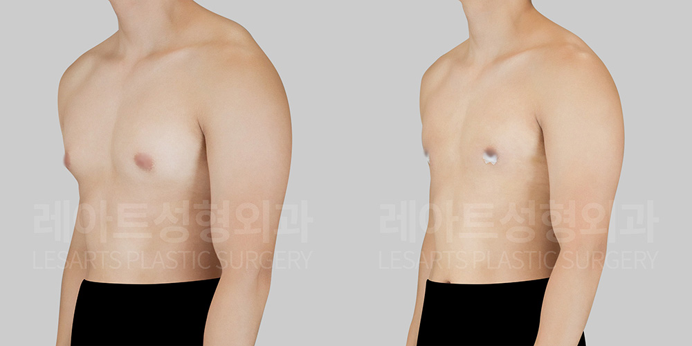 gynecomastia-33153-before-after-fit-45deg