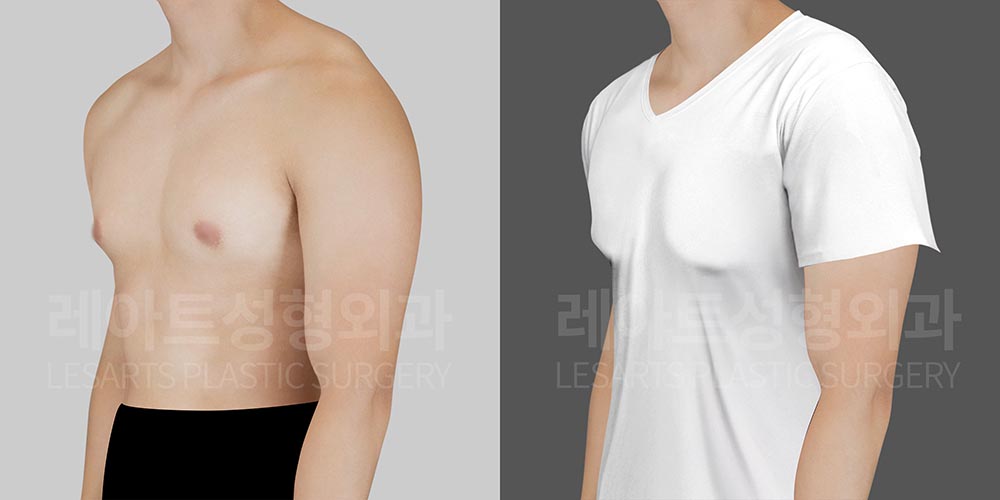 gynecomastia-33153-before-tshirt-fit-45deg