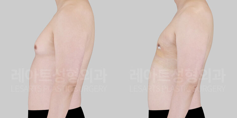gynecomastia-before-after-lesarts