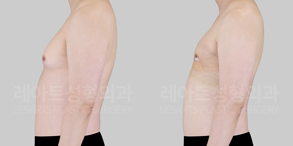 gynecomastia-before-after-lesarts