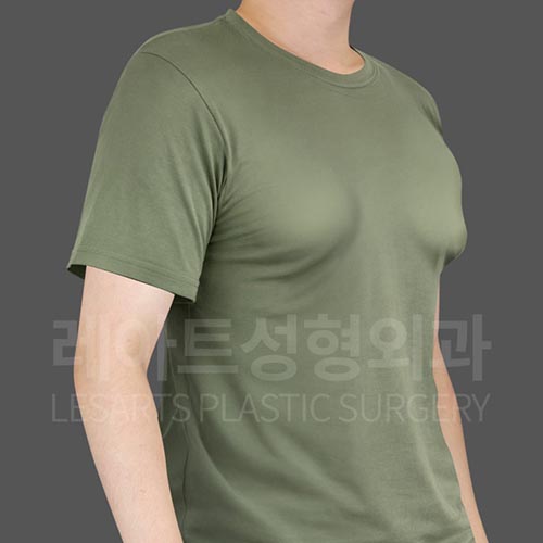 gynecomastia_before_45deg_25484