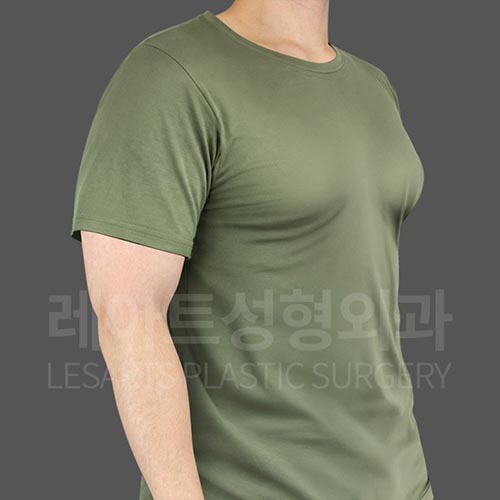 gynecomastia_before_45deg_26084
