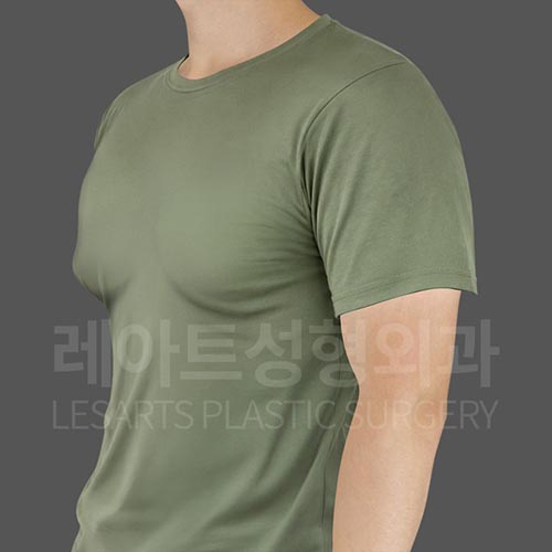 gynecomastia_before_45deg_28090
