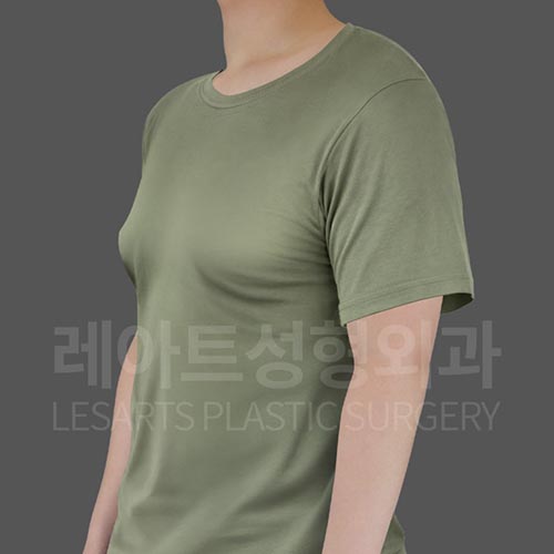 gynecomastia_before_45deg_28947