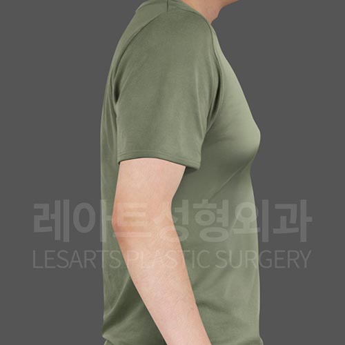 gynecomastia_before_side_25484