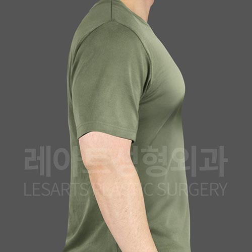 gynecomastia_before_side_26084
