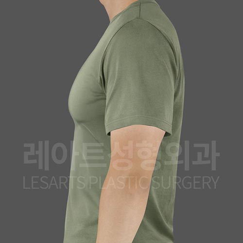 gynecomastia_before_side_28090