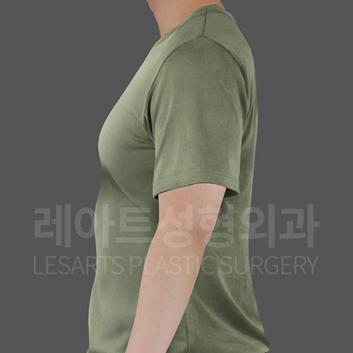 gynecomastia_before_side_28947