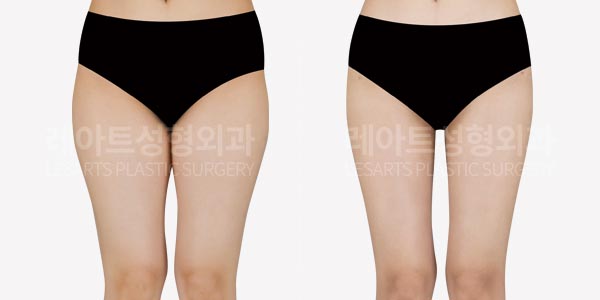 thigh liposuction before and after-lesarts plastic surgery