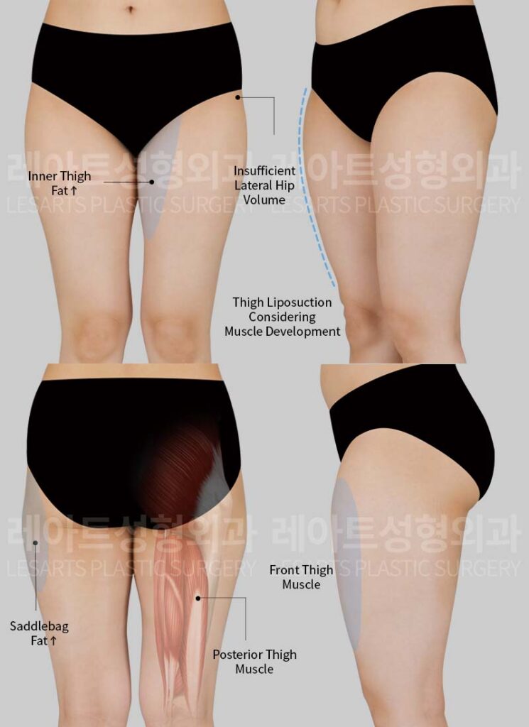 thigh-liposuction-02-01-260720