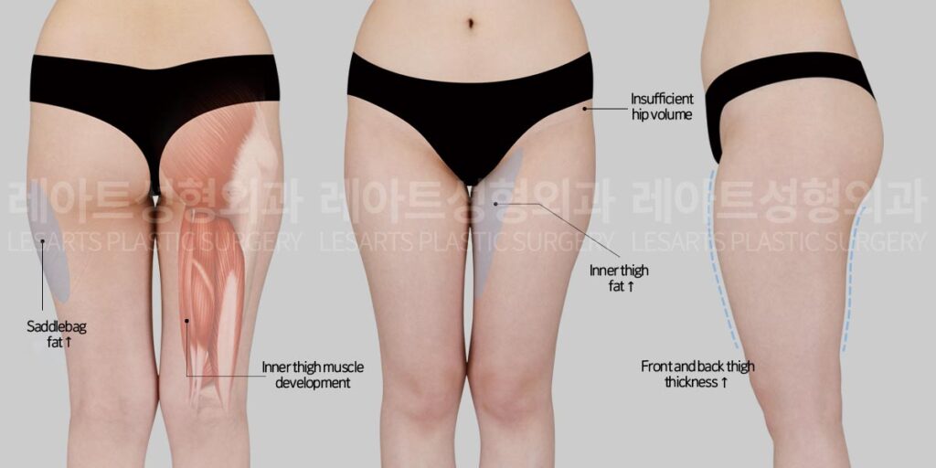 thigh-liposuction-02-01-260724