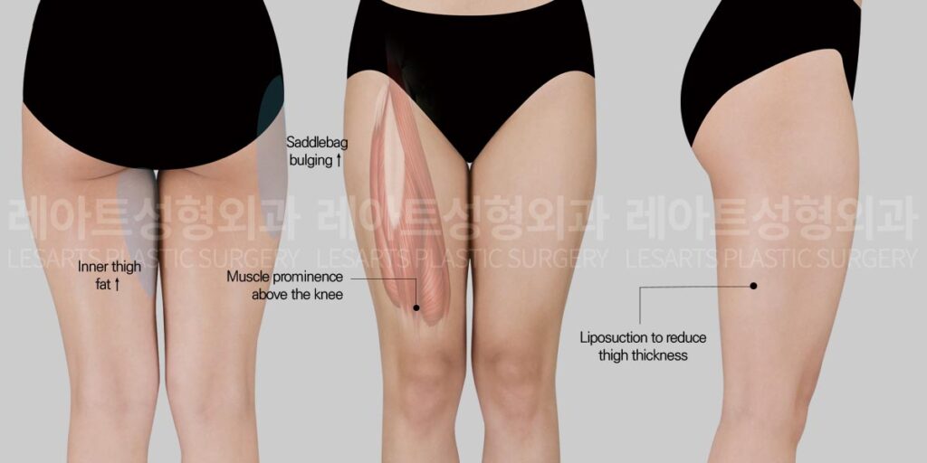 thigh-liposuction-02-01-260730