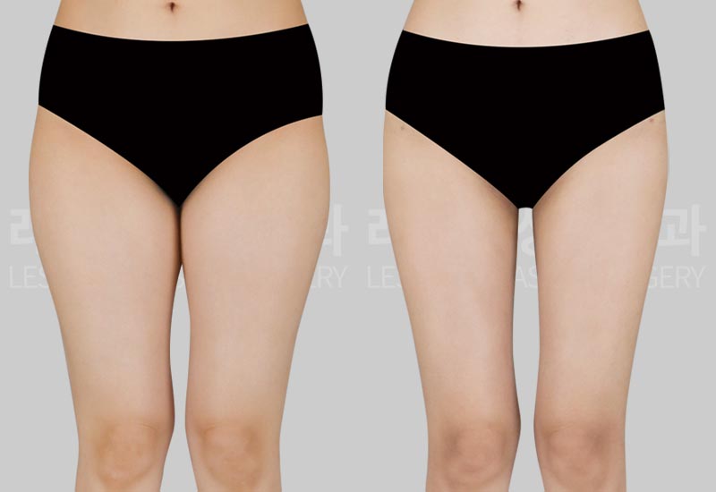 thigh-liposuction-02-02-260720