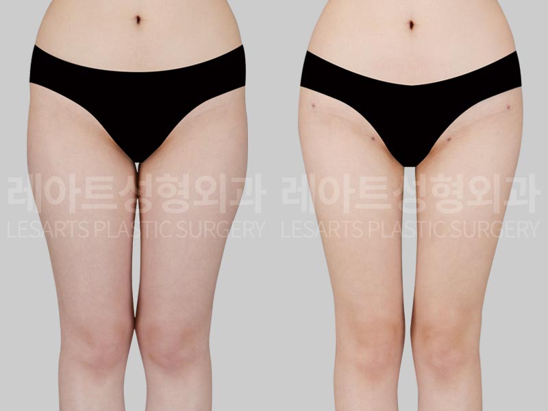 thigh-liposuction-02-02-260724