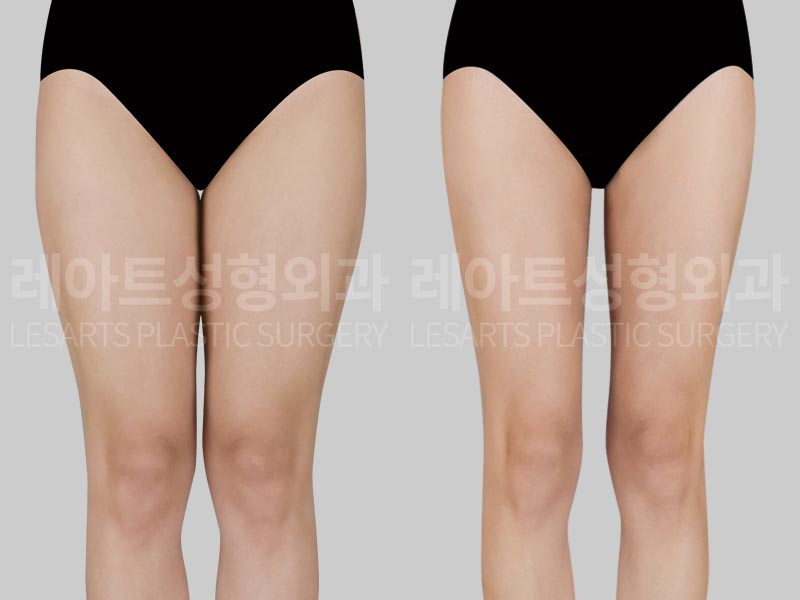 thigh-liposuction-02-02-260730