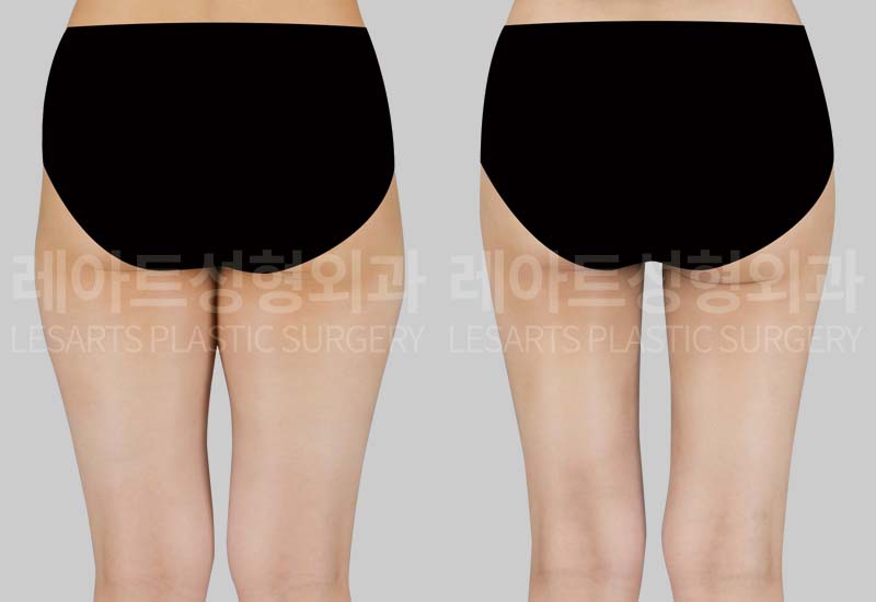 thigh-liposuction-02-03-260720