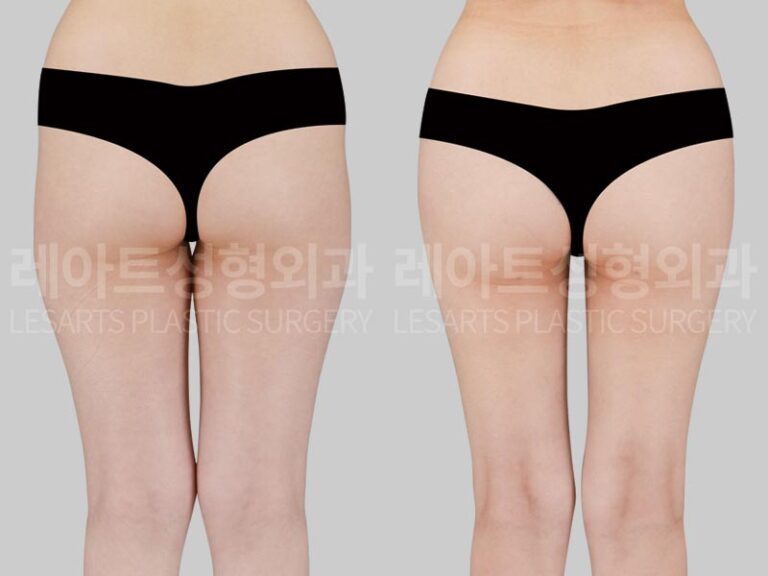 thigh liposuction before and after-lesarts plastic surgery