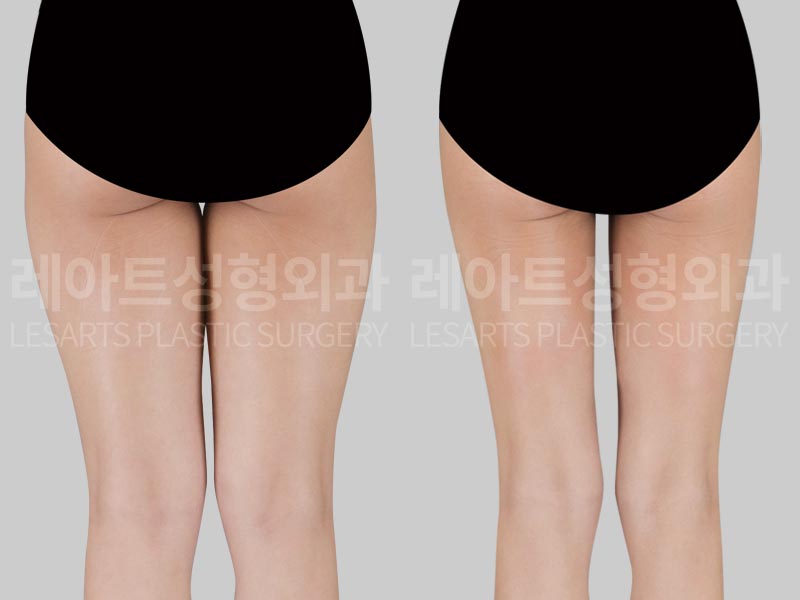 thigh-liposuction-02-03-260730