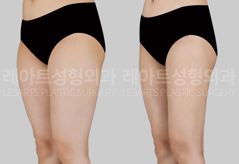 thigh-liposuction-02-04-260720