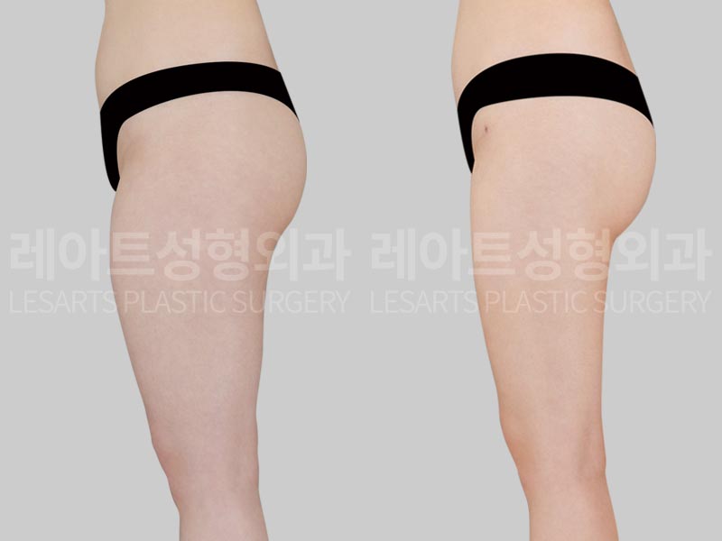 thigh-liposuction-02-04-260724
