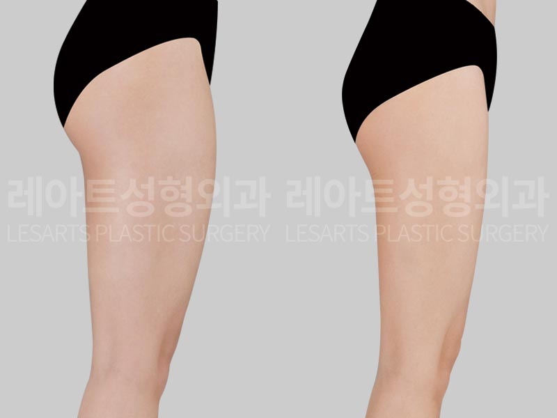 thigh-liposuction-02-04-260730