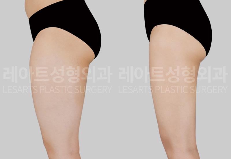 thigh-liposuction-02-05-260720