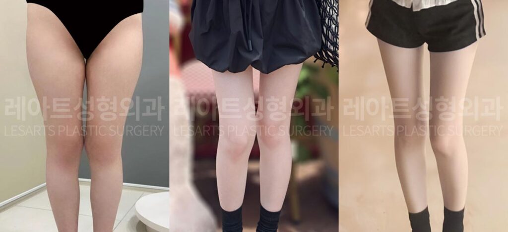 thigh-liposuction-02-05-260724