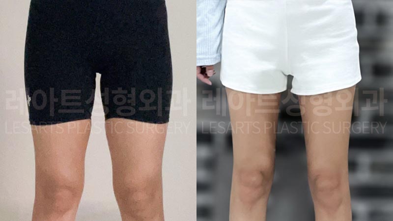 thigh-liposuction-02-05-260730