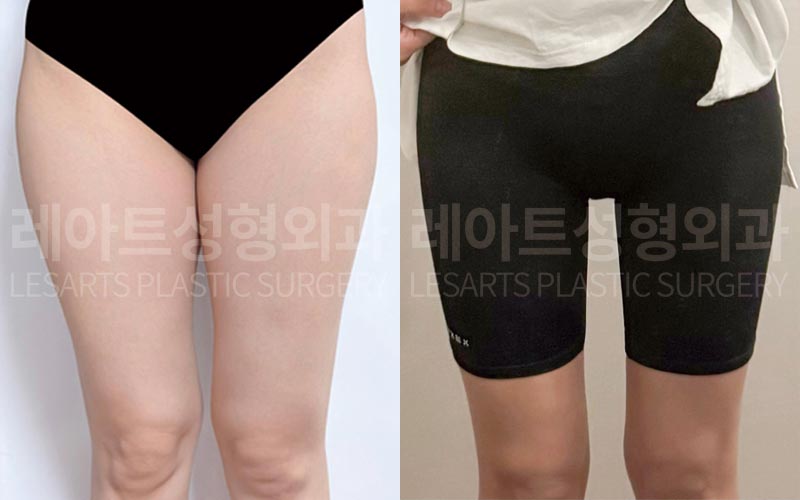 thigh-liposuction-02-06-260720