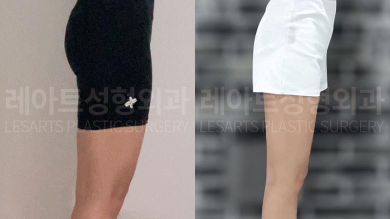 thigh-liposuction-02-06-260730