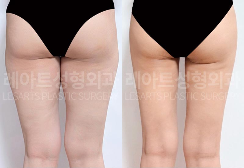 thigh-liposuction-02-07-260720