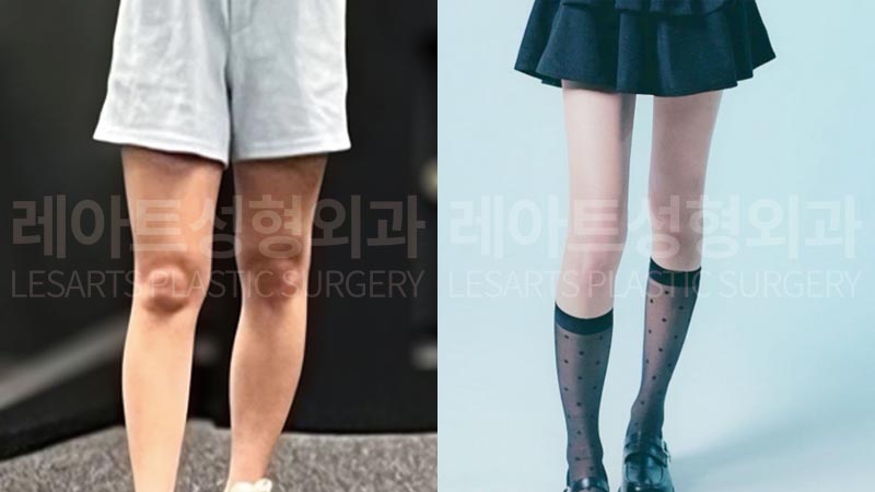 thigh-liposuction-02-07-260730