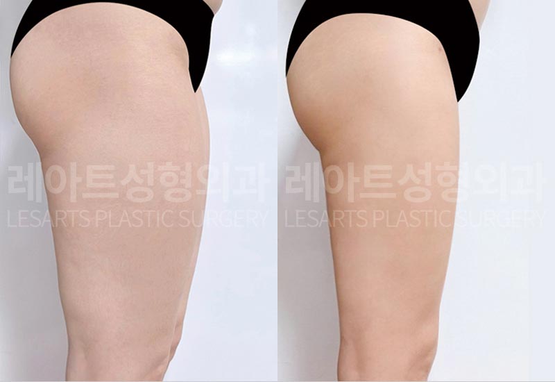 thigh-liposuction-02-08-260720